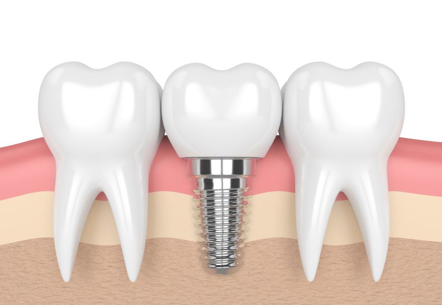 Dental Implants