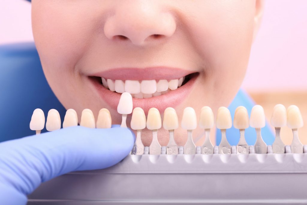 Tooth-Colored Fillings