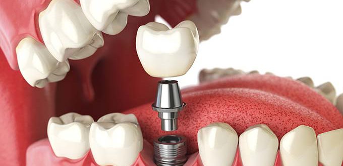 Dental Implants